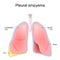 Pleural empyema. Normal lung and lungs after accumulation of pus