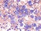 Pleural lymphoma, Cytology.