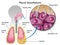 Pleural mesothelioma