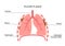 Pleural plaque poster