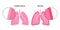 Pleurisy inflammation diseases