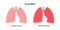 Pleurisy inflammation diseases