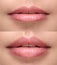 plump lips after filler injection