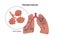 Pneumoconiosis lung disease