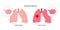 Pneumoconiosis lung disease