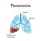 Pneumonia. The anatomical structure of the human