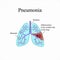 Pneumonia. The anatomical structure of the human lung. Inflammat