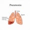 Pneumonia. The anatomical structure of the human lung. Inflammation of the lower lobe of the lung. Vector illustration