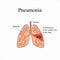 Pneumonia. The anatomical structure of the human lung. Inflammation of the middle lobe of the lung. Vector illustration