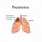 Pneumonia. The anatomical structure of the human lung. Inflammation of the upper lobe of the lung. Vector illustration