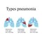 Pneumonia. The anatomical structure of the human lung. Type of pneumonia. Vector illustration on background