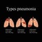 Pneumonia. The anatomical structure of the human lung. Type of pneumonia. Vector illustration on a black background