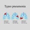 Pneumonia. The anatomical structure of the human lung. Type of pneumonia. Vector illustration on a gray background