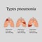 Pneumonia. The anatomical structure of the human lung. Type of pneumonia. Vector illustration on a gray background