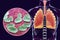 Pneumonia caused by Haemophilus influenzae bacteria, medical concept