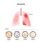 Pneumonia is caused by infection with viruses, bacteria, fungi and microorganism