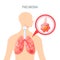 Pneumonia disease vector icon in flat style