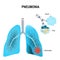 Pneumonia. human lungs, and inflamed alveoli