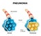 Pneumonia. Illustration shows normal and infected