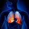 Pneumonia - Lungs Inflammatory Condition - anatomy