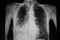 pneumonia right lower lung