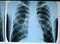 Pneumonia test scanning, modern x-rays radiography.