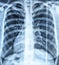 Pneumonia virus lung bones radiograph snapshot