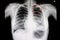 Pneumothorax