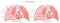 Pneumothorax. Abnormal gathering of air in pleural space. Collapsed lung.