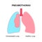 Pneumothorax anatomical poster