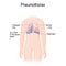 Pneumothorax. Collapsed lung.