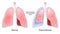 Pneumothorax. Normal, and collapsed lungs