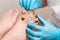 Podiatrist in blue gloves inserts a silicone impression to fix the ingrown toenail on the client& x27;s big toe. Close-up