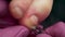 A podiatrist treats a diseased, deformed nail with fungus. Cuts the skin and cuticle around the toenail