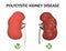 Polycystic kidney disease and healthy kidney. medical infographics. Vector illustration