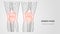 Polygonal vector illustration of pain, inflammation or injury in knees. Human legs bones anatomy.