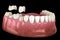 Porcelain crowns placement over premolar and molar teeth. . Medically accurate 3D illustration