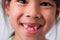 Portrait of an Asian girl with broken upper baby teeth and first permanent teeth. Friendly little girl showing her broken teeth