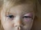 Portrait of caucasian child of two years old with the bruise on face on left eye