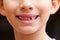 Portrait child missing milk tooth outdoor