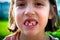 Portrait of toothless child girl missing milk and permanent teeth.