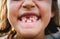 Portrait of toothless child girl missing milk and permanent teeth.