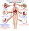 Positive and negative effects of vegan diet, 3d medical vector illustration