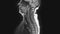 Postoperative voluminous MRI of female organs for the detection of metastases