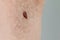 Precancerous mole on armpit - birthmark is potentially cancerous melanoma