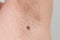 Precancerous mole on armpit - birthmark is potentially cancerous melanoma