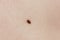 Precancerous mole - birthmark is potentially cancerous melanoma