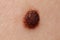 Precancerous mole - birthmark is potentially cancerous melanoma