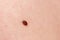 Precancerous mole - birthmark is potentially cancerous melanoma