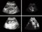 Pregnancy, fetus developing by ultrasound.